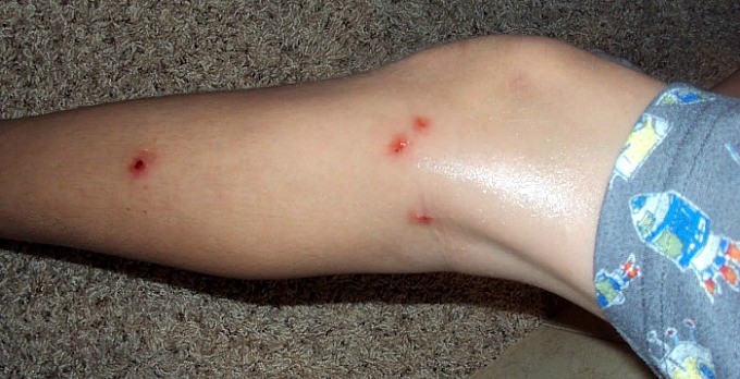 Detox Rashes