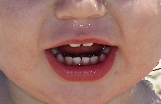 Can Tooth Decay be Healed Naturally?